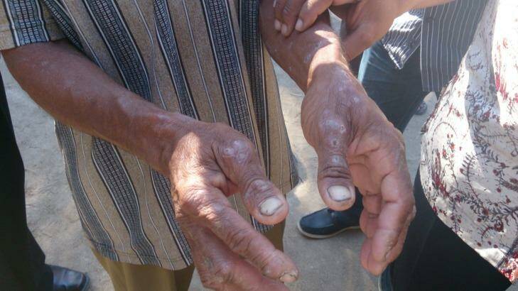 The hands of a local resident in Tablolong taken in August, 2013. People in the region complain of itchy skin conditions.  Photo: Australian Lawyers Alliance