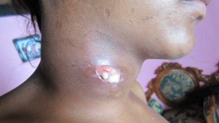 A West Timor local resident shows a neck cyst in 2011.  Photo: West Timor Care Foundation