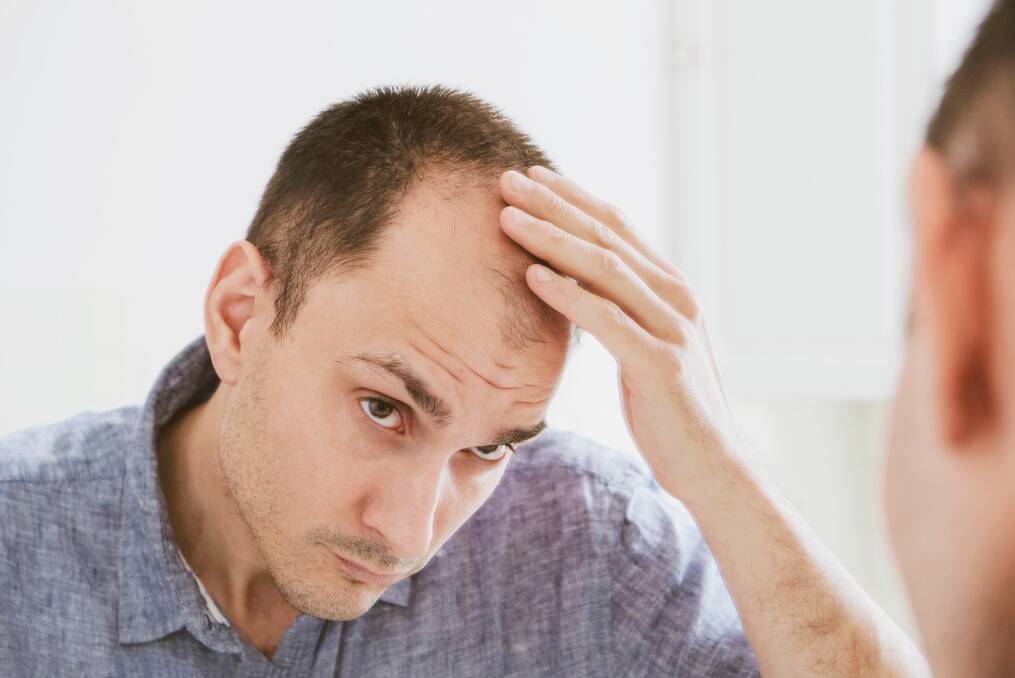 Hair transplantation is a highly personal decision, and not all people experiencing baldness decide to undertake surgery in order to treat their hair loss. Picture: Shutterstock. 