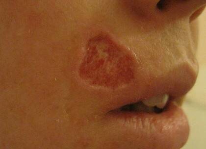 The burn occurred during dental work.
